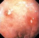 MALT LYMPHOMA