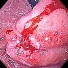 MALT LYMPHOMA