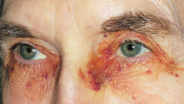 MULTIPLE MYELOMA