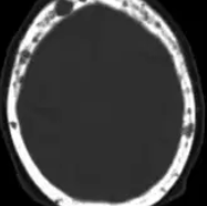 MYELOMA - BONE LESIONS