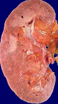 MYELOMA - KIDNEY