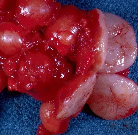 NODAL DIFFUSE B - CELL LYMPHOMA