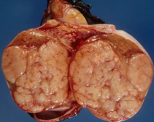 TESTICULAR PLASMACYTOMA