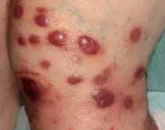PRIMARY CUTANEOUS LARGE B - CELL LYMPHOMA1