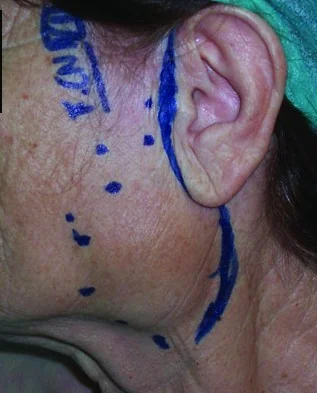 PRIMARY PAROTID GLAND LYMPHOMA 