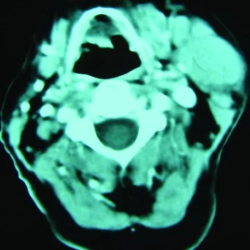 PRIMARY PAROTID GLAND LYMPHOMA