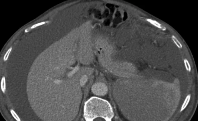 PRIMARY SPLENIC LYMPHOMA
