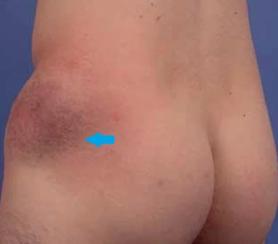 SKIN LYMPHOMA
