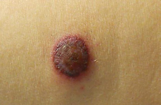 SKIN LYMPHOMA 