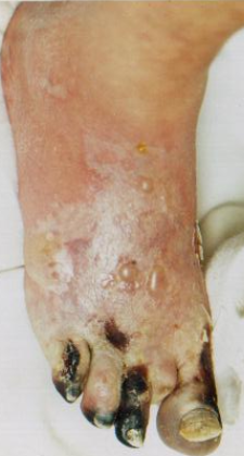 WET GANGRENE
