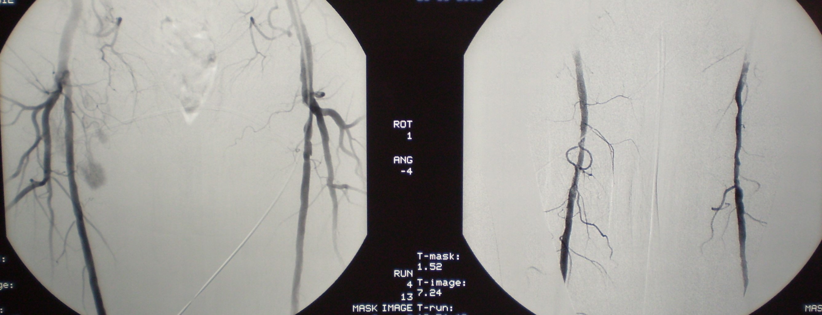 DIABETIC ANGIOPATHY