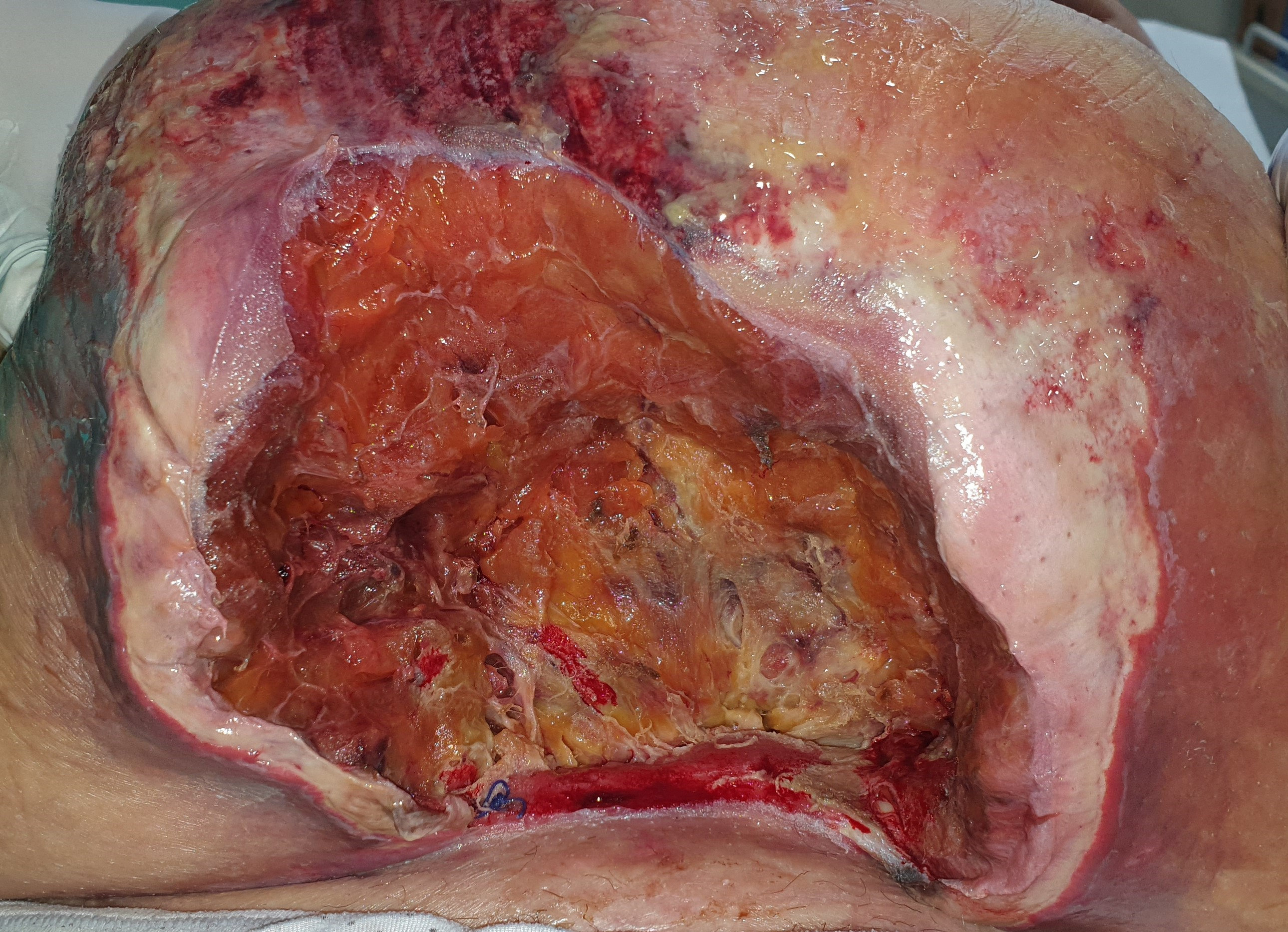 ABDOMINAL WALL GANGRENE