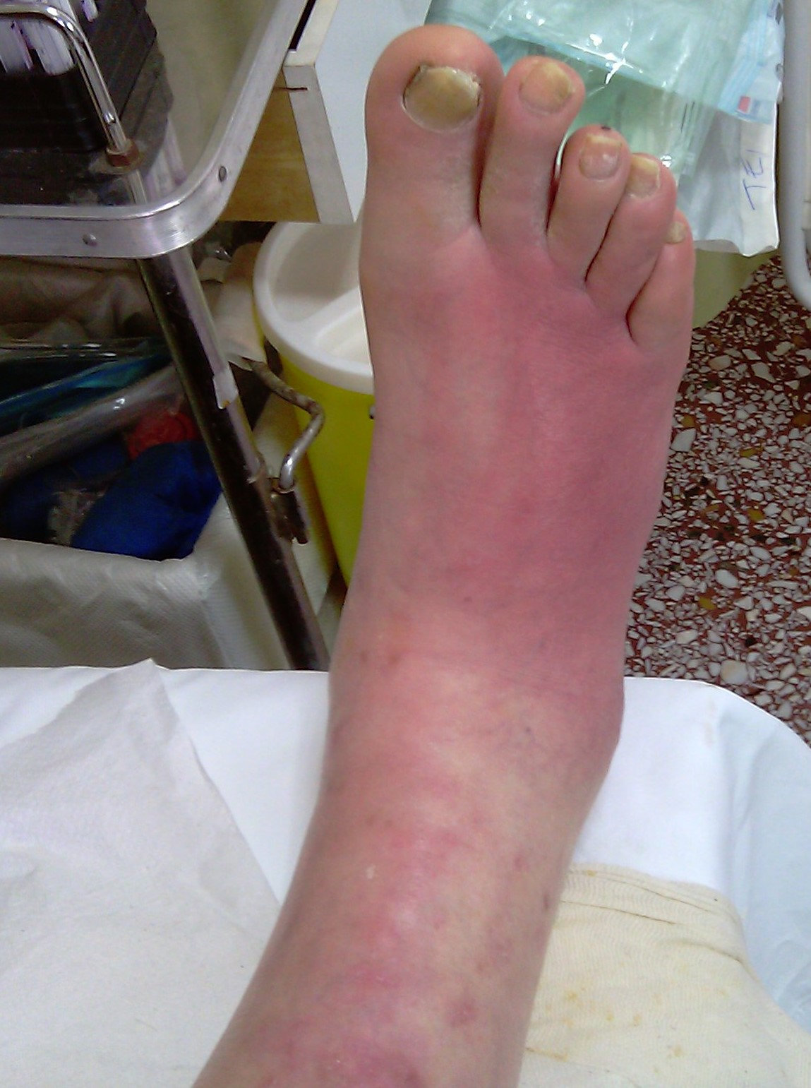 DIABETIC FOOT