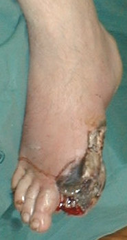 WET GANGRENE