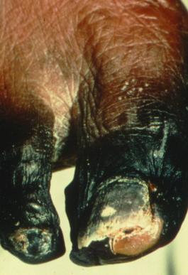 DRY GANGRENE