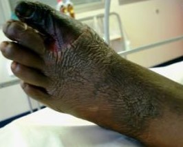 WET GANGRENE