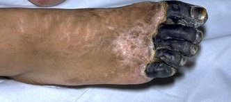 DRY GANGRENE