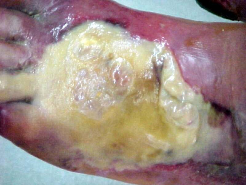 GANGRENE