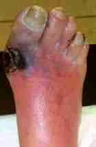 GANGRENE 