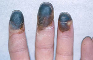 GANGRENE