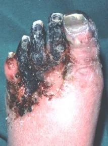 GANGRENE