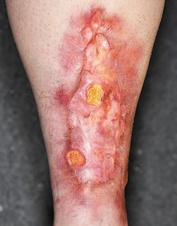 NECROBIOSIS LIPOIDICA DIABETICORUM