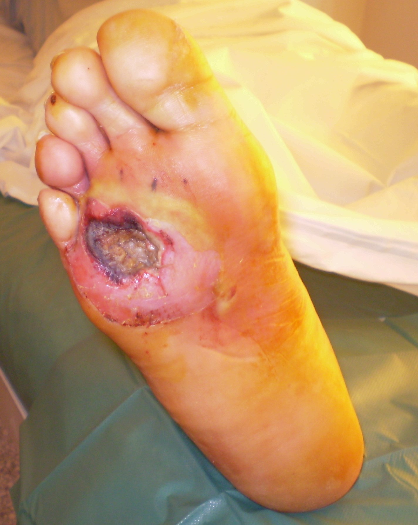 DIABETIC ANGIOPATHY
