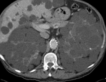 POLYCYSTIC LIVER - KIDNEY DISEASE