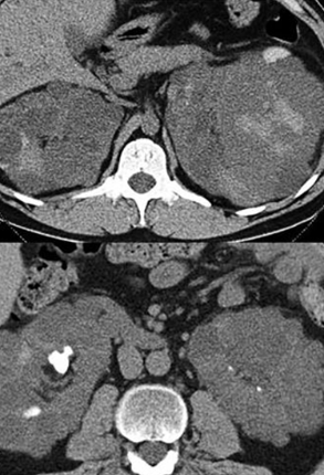CYSTIC KIDNEY DISEASE