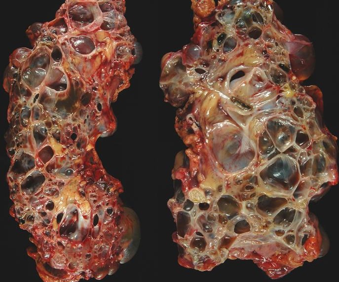 CYSTIC KIDNEY DISEASE