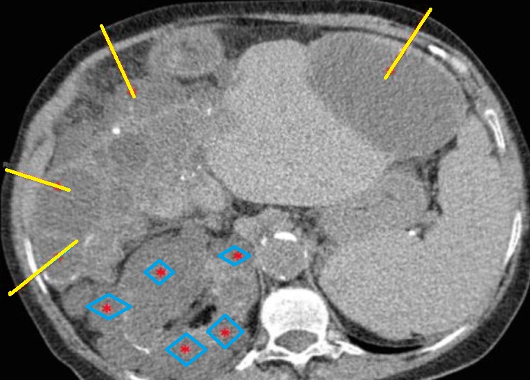 CYSTIC LIVER - KIDNEY DISEASE