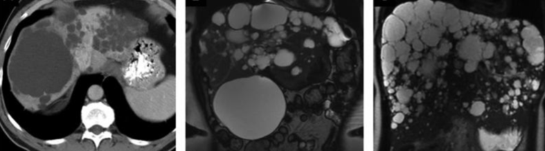 CYSTIC LIVER DISEASE