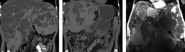 CYSTIC LIVER DISEASE