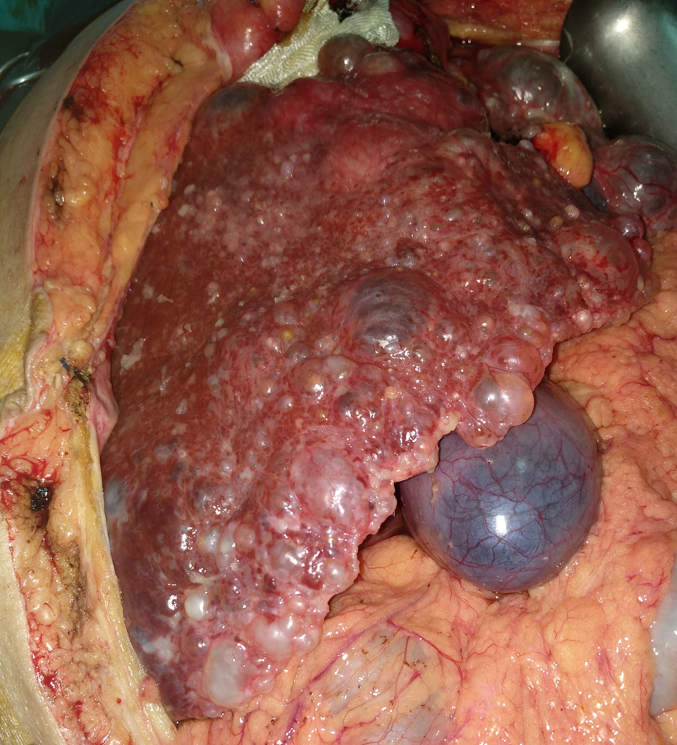 CYSTIC LIVER DISEASE