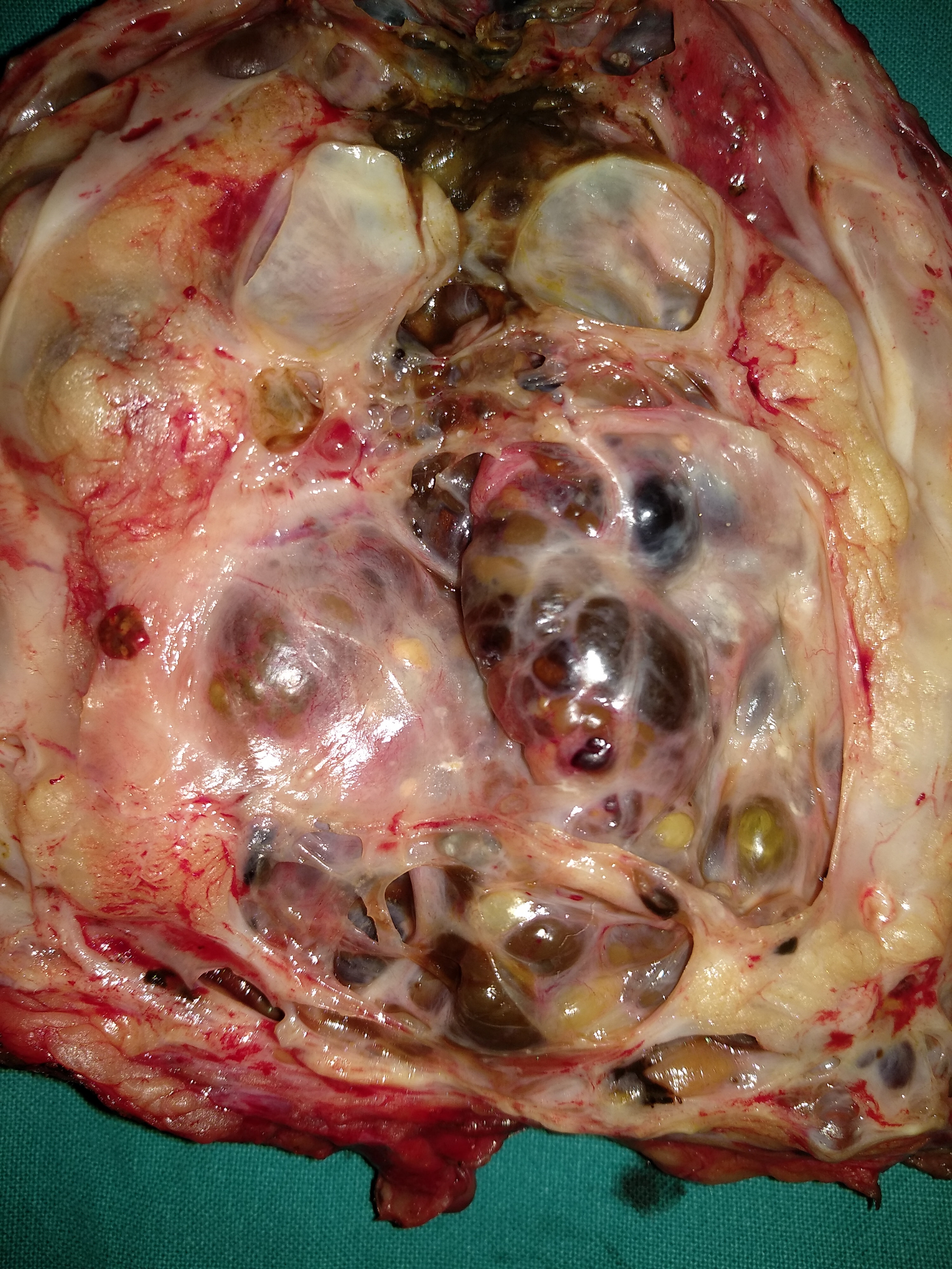 CYSTIC KIDNEY DISEASE