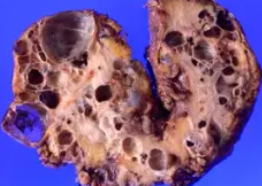 POLYCYSTIC HORSESHOE KIDNEY