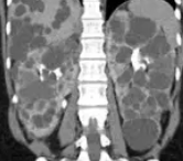 POLYCYSTIC KIDNEY DISEASE