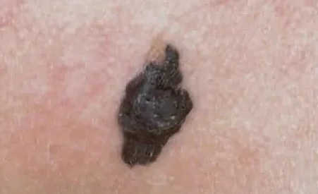 MELANOMA