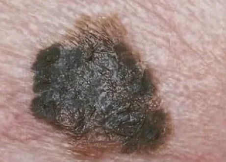 MELANOMA