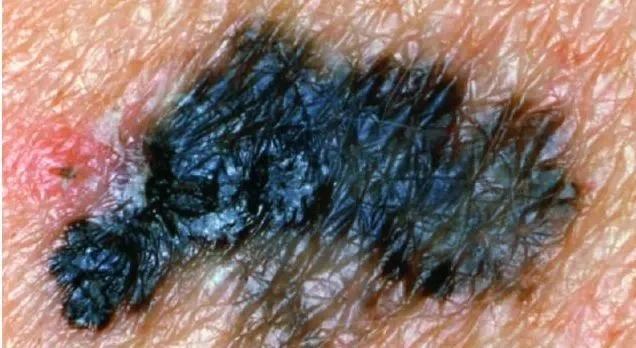 MELANOMA
