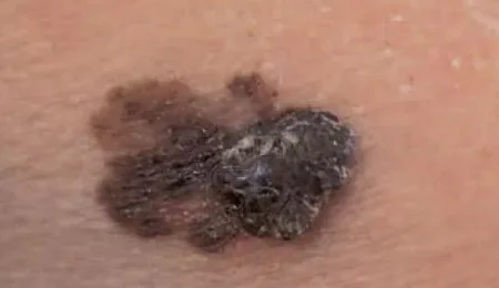 MELANOMA