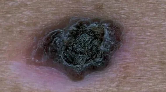 MELANOMA
