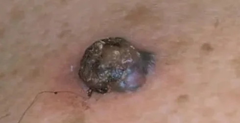 MELANOMA