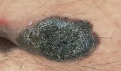 MELANOMA