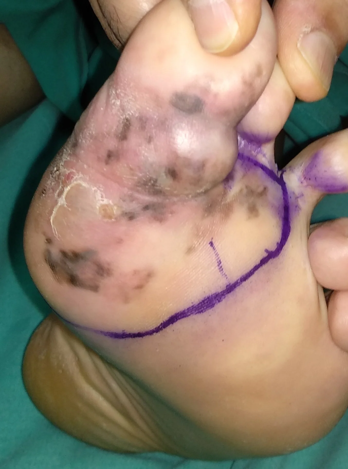 FOOT MELANOMA