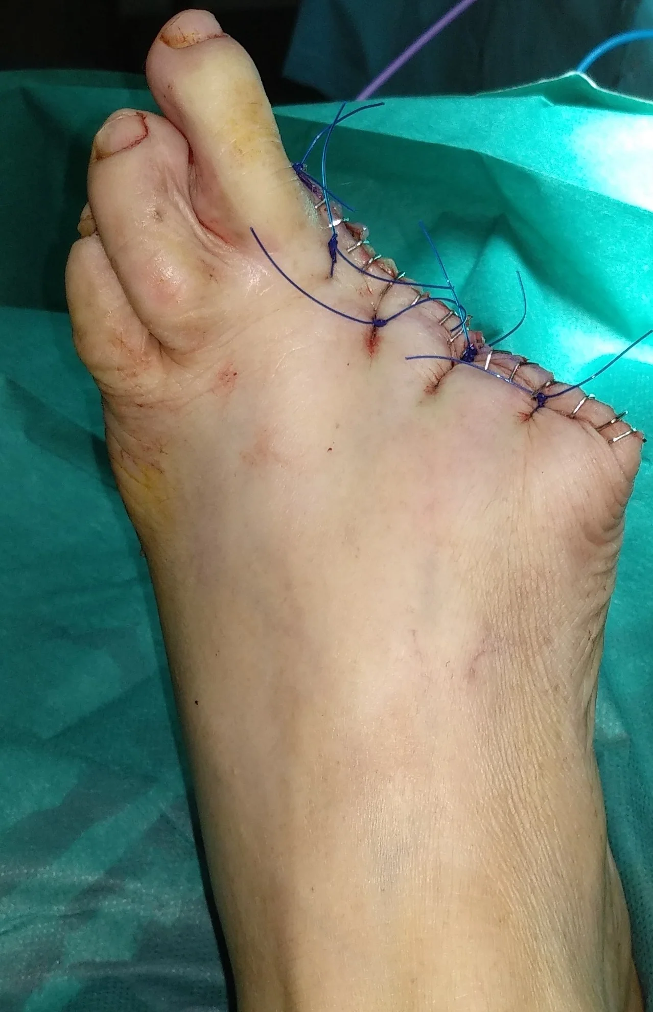 FOOT MELANOMA - DIGITAL AMPUTATION