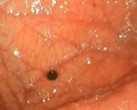 GASTRIC MELANOMA
