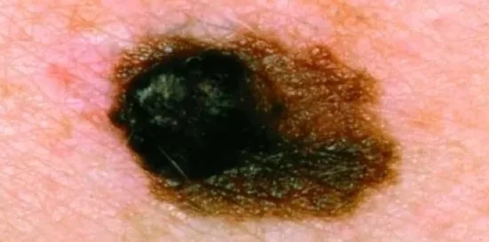 MELANOMA