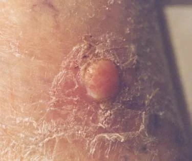 AMELANOTIC MELANOMA