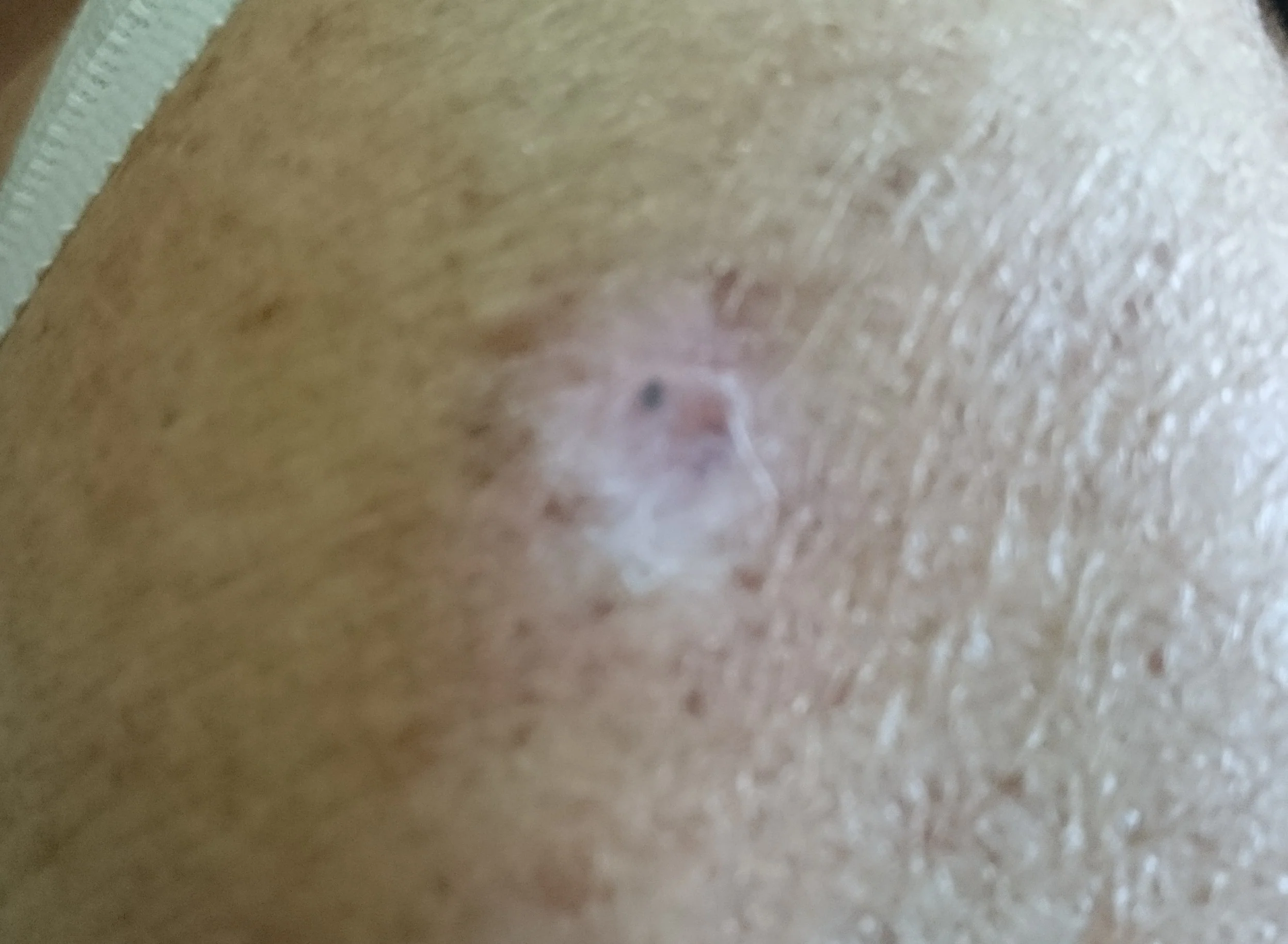 AMELANOTIC MELANOMA